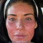 Microneedling