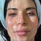 Microneedling